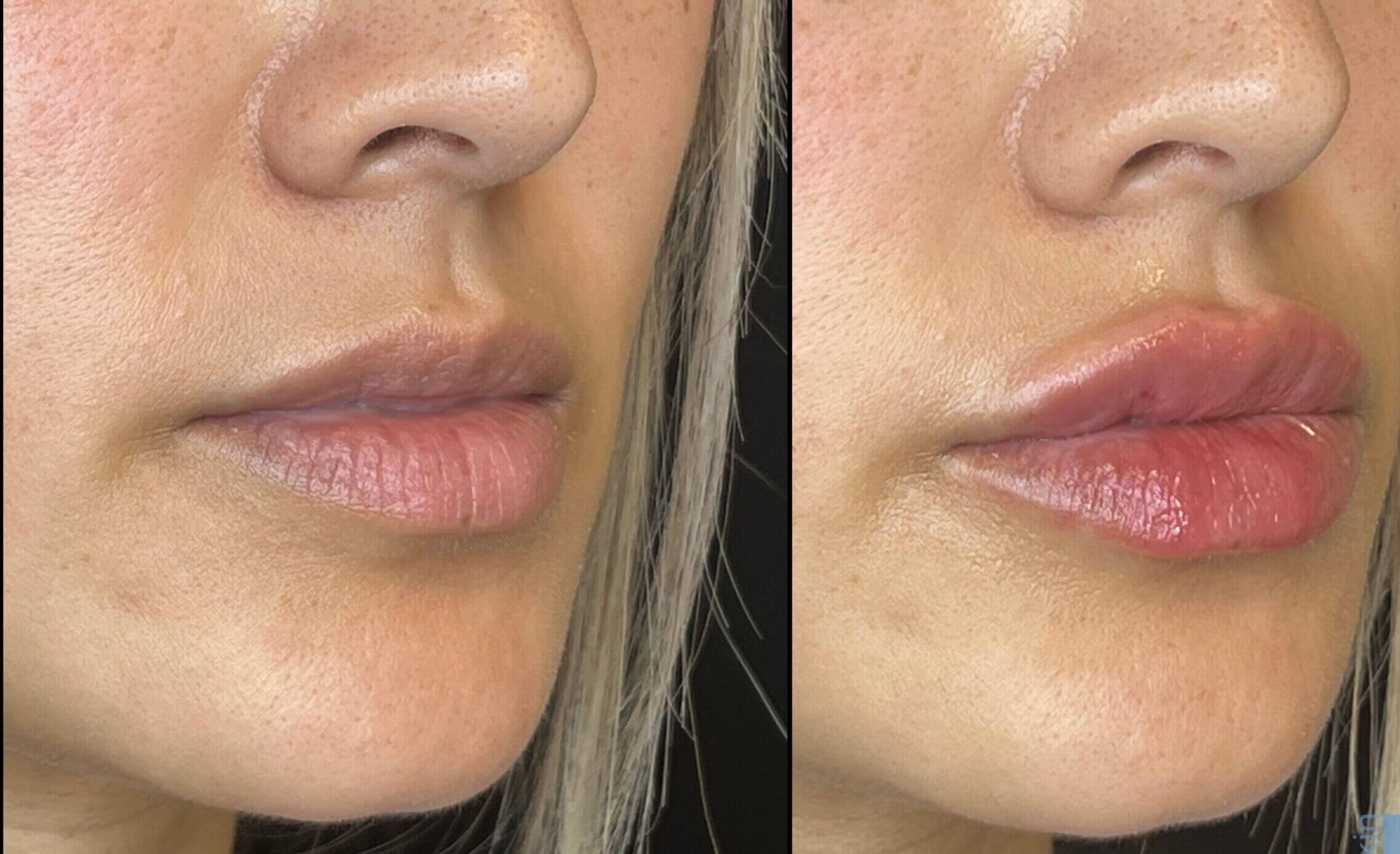 Lip Fillers